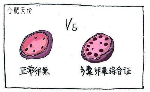 什么原因导致女性患多囊卵巢