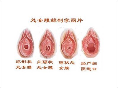 自己处女膜破没破怎么知道