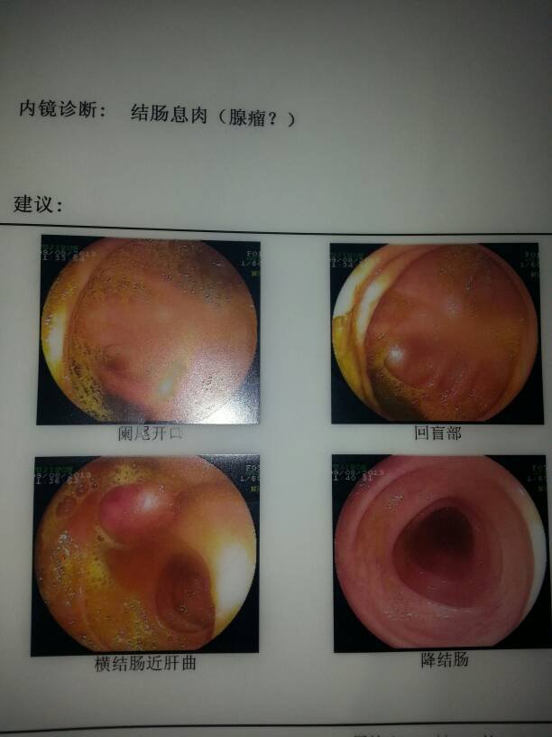结肠息肉的治疗