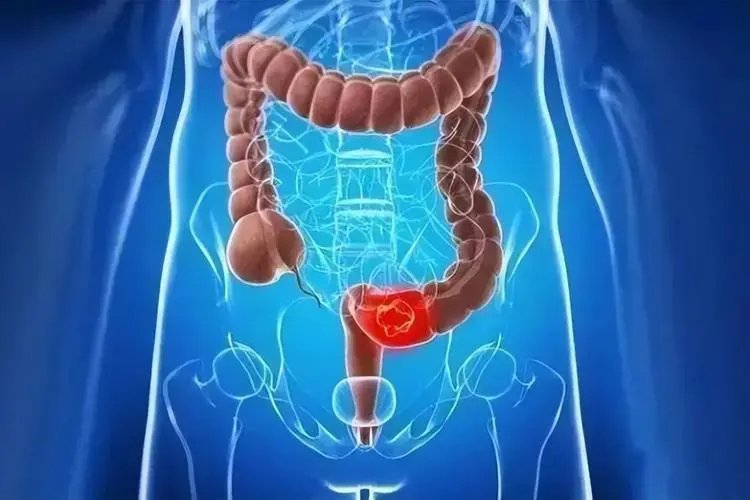 一家10口7人患肠癌，哪些情况会引发肠癌的发生率？