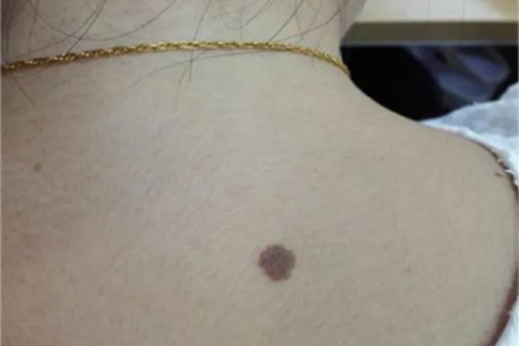 发育不良痣皮肤长痣图片