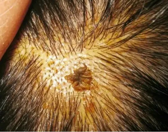 身体上长瘊子图片