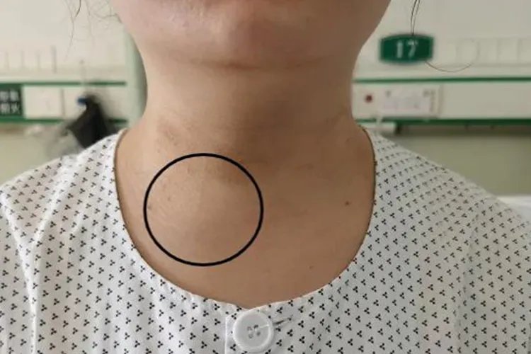 脖子右侧甲状腺肿大图片