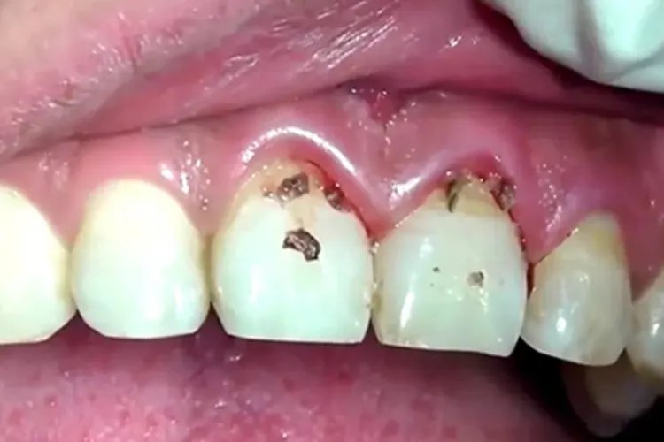 牙结石症状图片