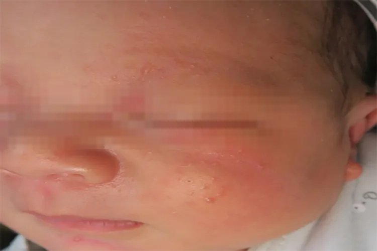 小儿丘疹图片