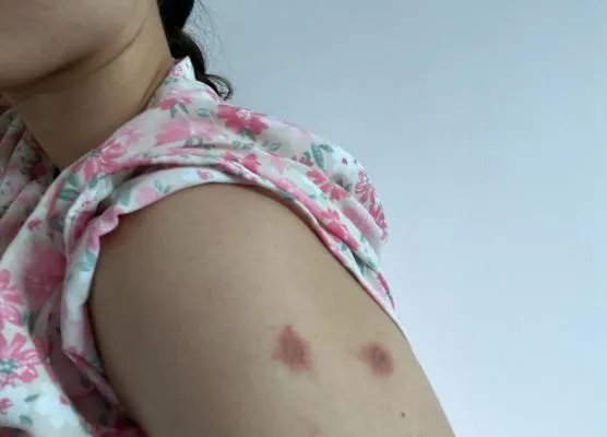 隐翅虫咬人后图片，网友实拍五花八门隐翅虫咬伤后画面