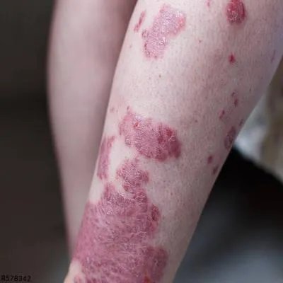 紫癜肾炎应注意哪些事项