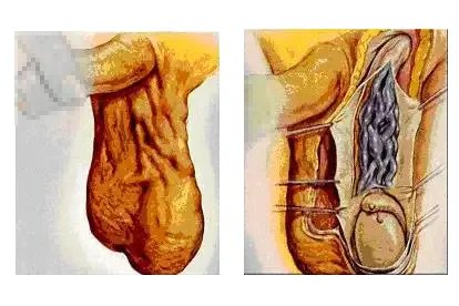 精索静脉曲张的图片