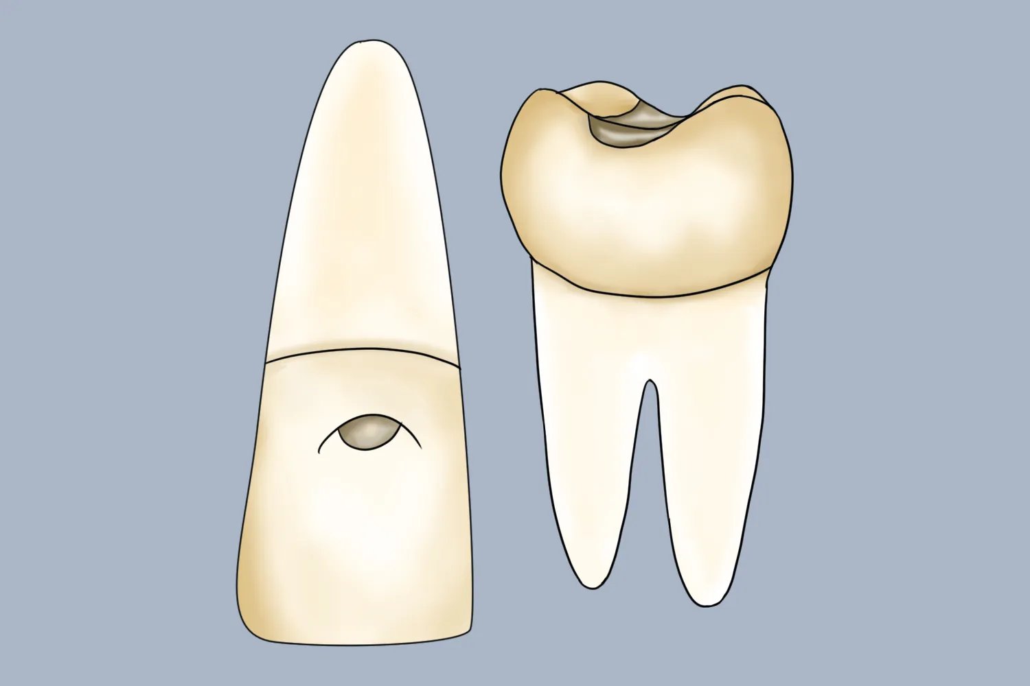 牙齿洞型分类及图片