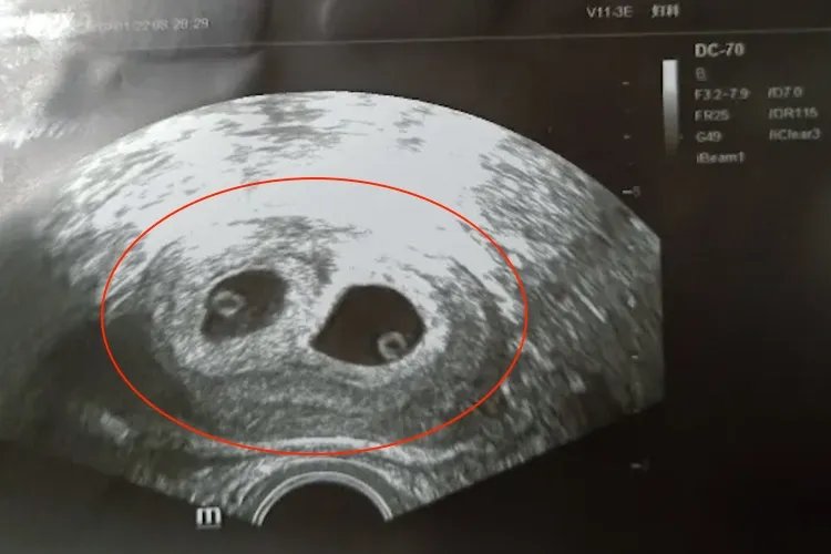 35天孕囊双胞胎图片