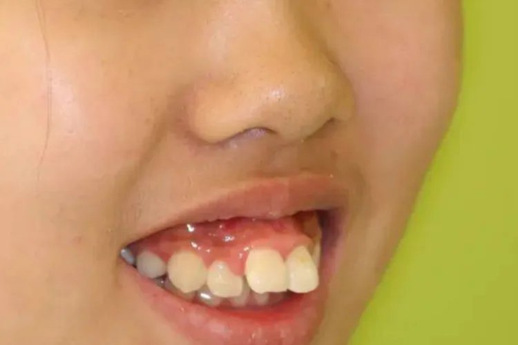 儿童严重大龅牙图片