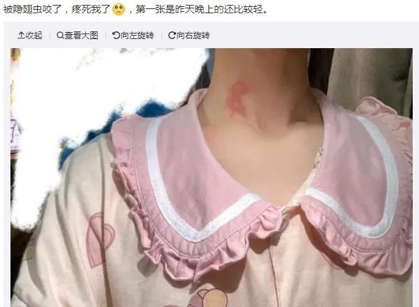 隐翅虫咬人后图片，网友实拍五花八门隐翅虫咬伤后画面