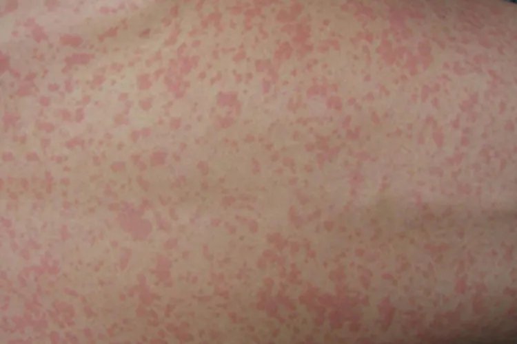 麻疹丘疹图片