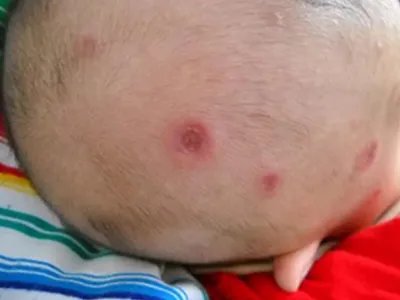 新生儿红斑狼疮红斑图片