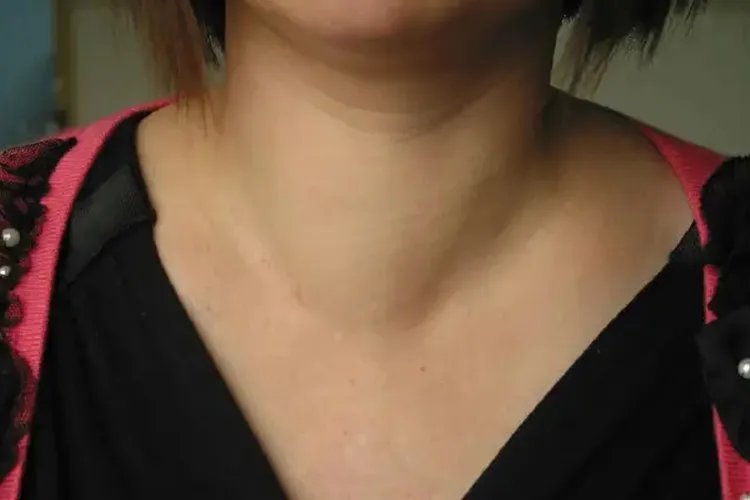 脖子右侧甲状腺肿大图片