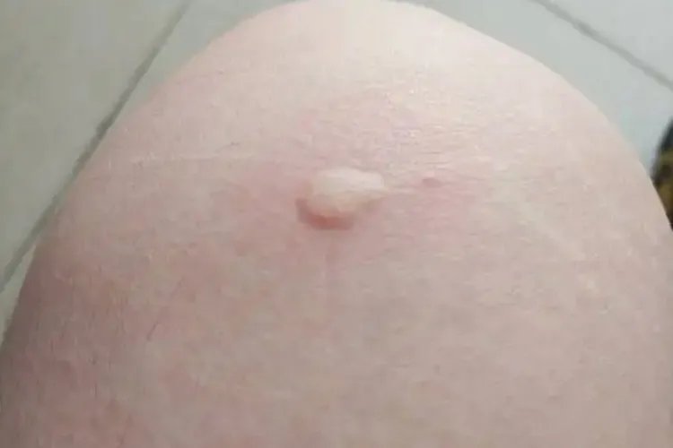 各种虫咬性皮炎过敏图片