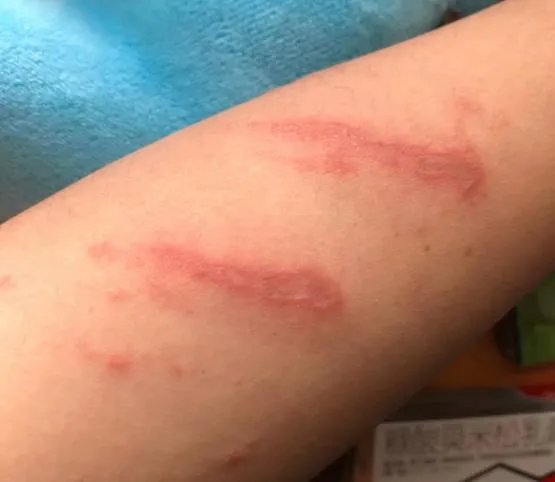 隐翅虫咬人后图片，网友实拍五花八门隐翅虫咬伤后画面