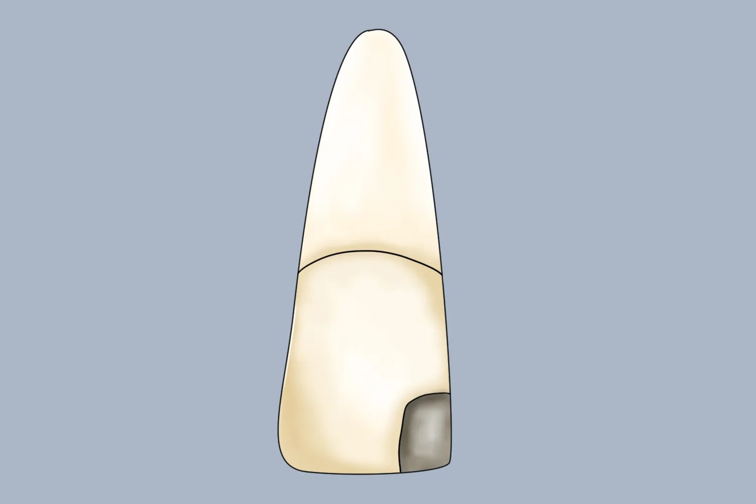 牙齿洞型分类及图片