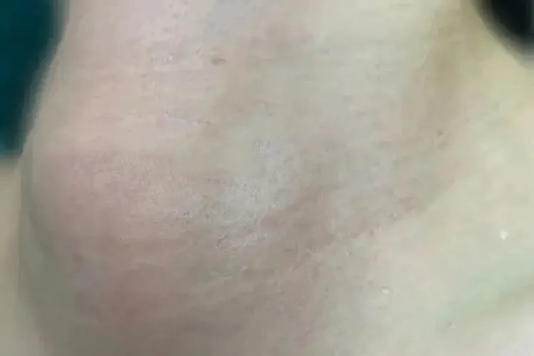 脖子右侧甲状腺肿大图片