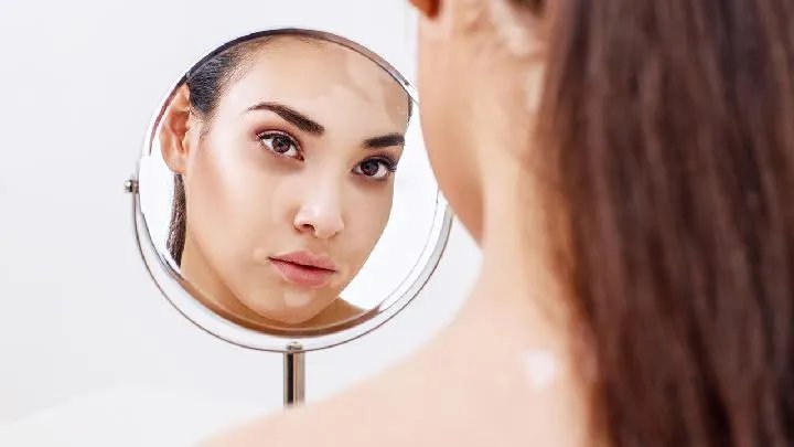 白癜风怎么得的呢