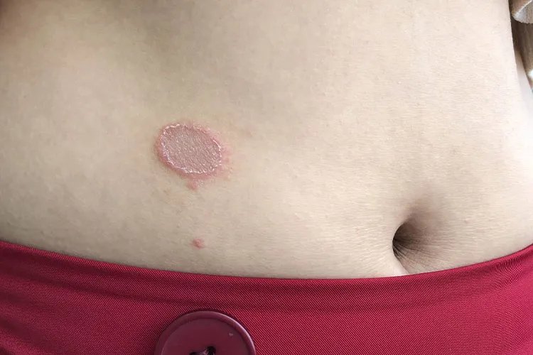 癣长什么样图片