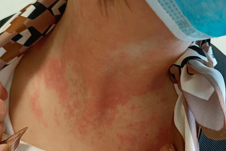 红疹初期症状图片