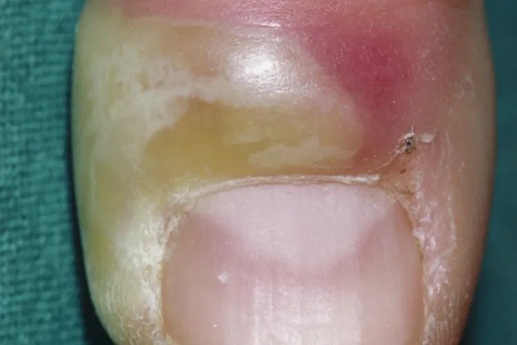 甲沟炎化脓图片