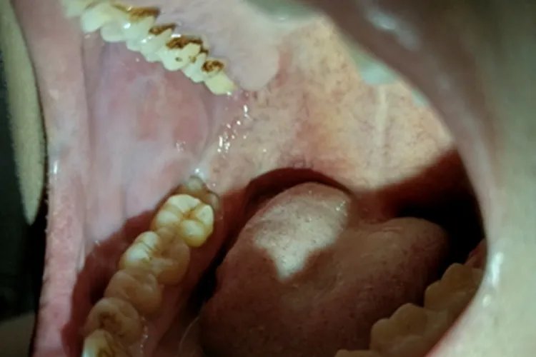 牙结石症状图片