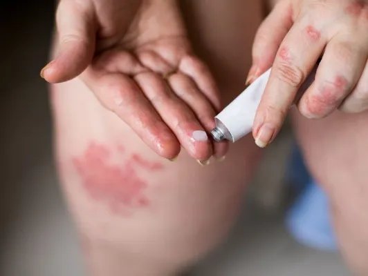 红霉素眼药膏的作用是什么