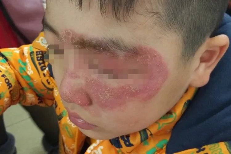 癣长什么样图片