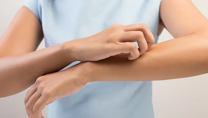 荨麻疹会传染吗