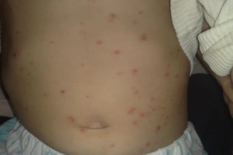 宝宝出水痘图片