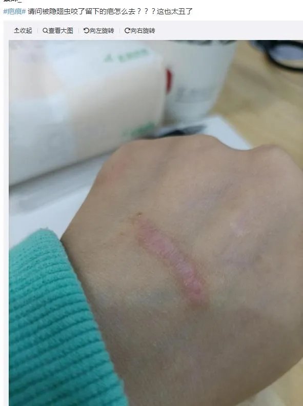 隐翅虫咬人后图片，网友实拍五花八门隐翅虫咬伤后画面
