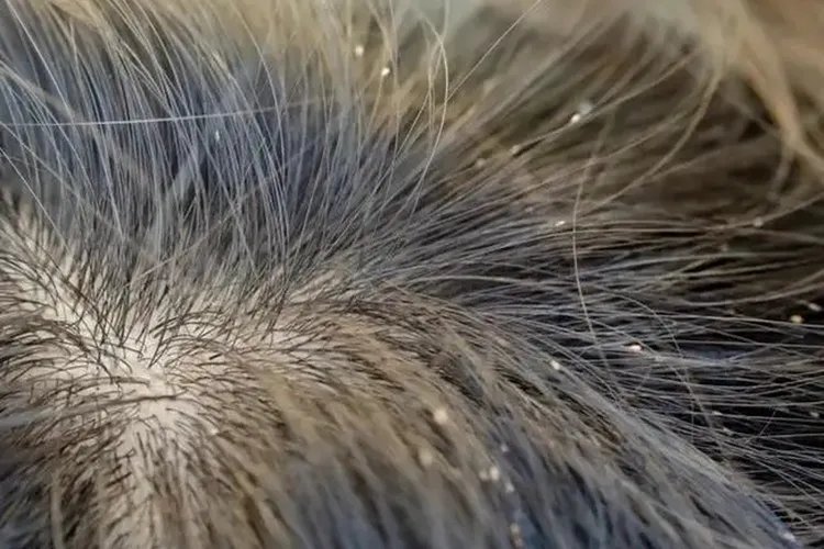 小孩头上长虱子图片