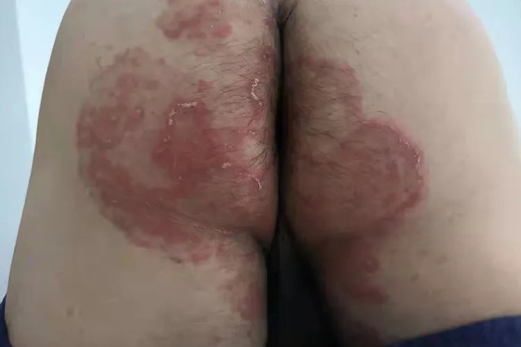 癣长什么样图片