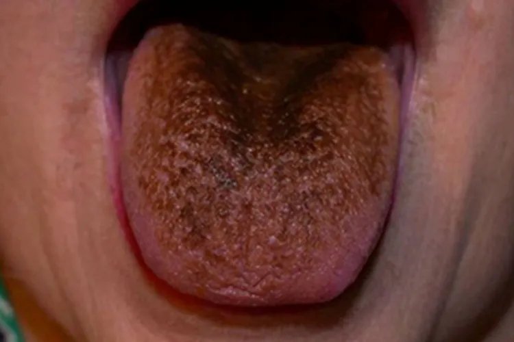 黑毛舌舌头发黑图片