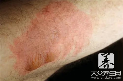 鱼石脂软膏的作用是什么呢？