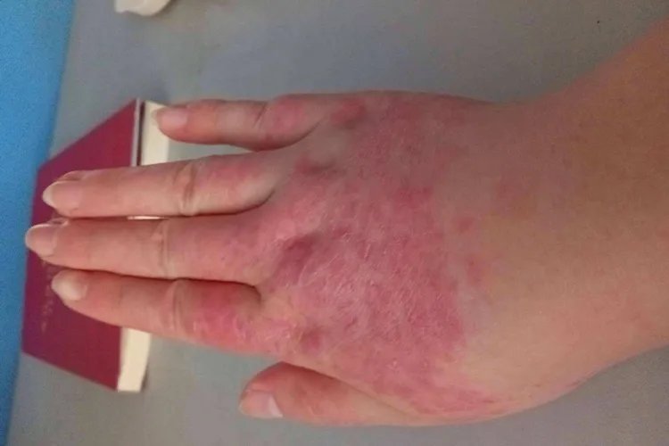 自身免疫性皮炎图片