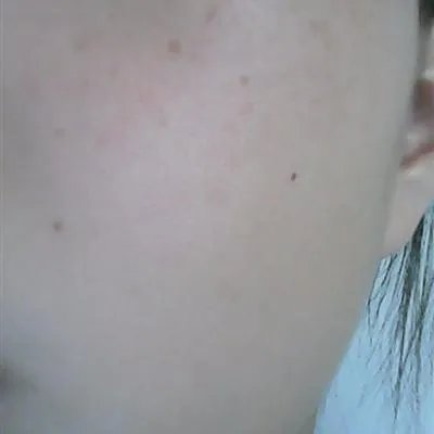 小雀斑怎么去除