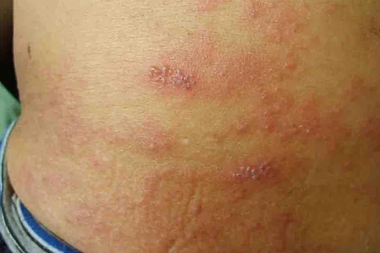 蛇盘疮初期图片