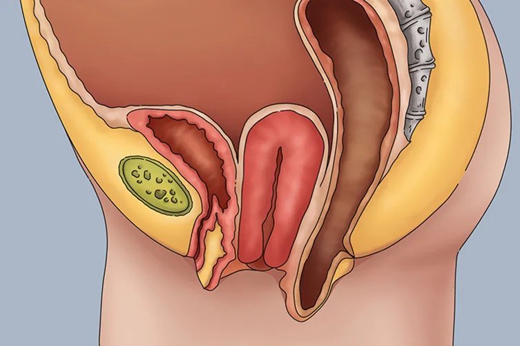 子宫下垂有什么办法恢复正常图片