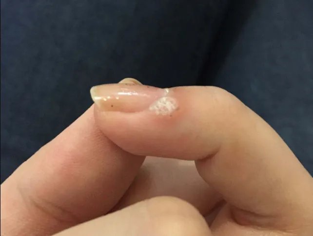 身体上长瘊子图片