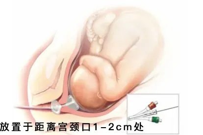 宫颈扩张球囊使用说明图示