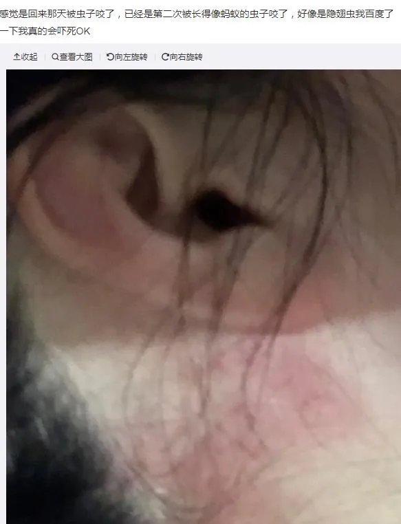 隐翅虫咬人后图片，网友实拍五花八门隐翅虫咬伤后画面