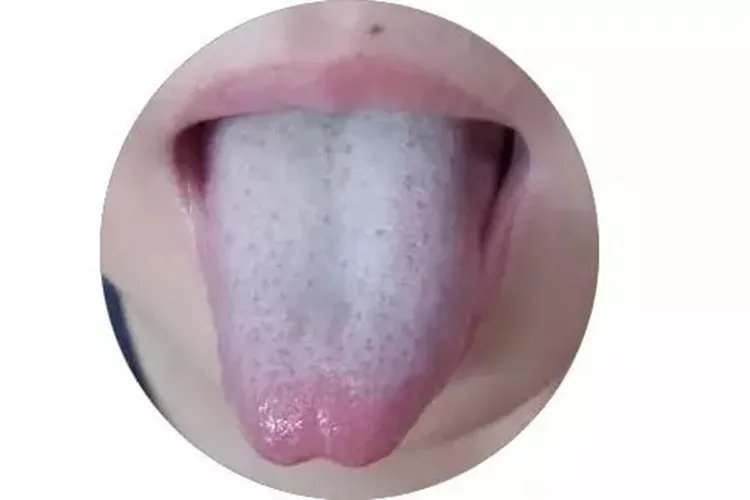 舌苔发白图片