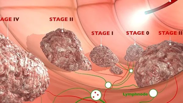 淋巴细胞百分比偏低的原因
