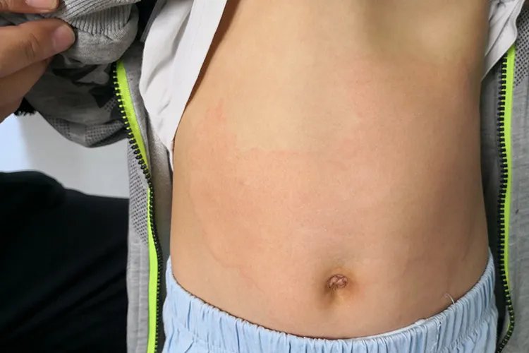 儿童荨麻疹的主要症状图片