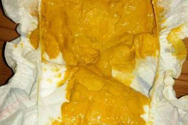 新生儿便便图片分析