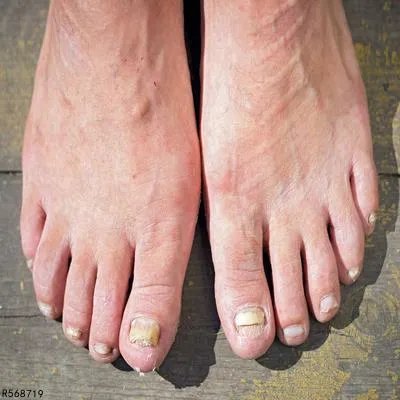 真菌感染水泡要刺破吗 应该怎么预防真菌感染