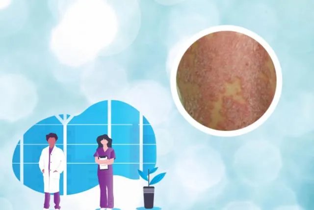 皮肤病 拍图识别-皮肤病图片识别